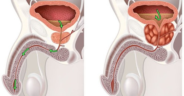Prostat vəzinin adenoması, (xoşxəssəli hiperplaziyası).